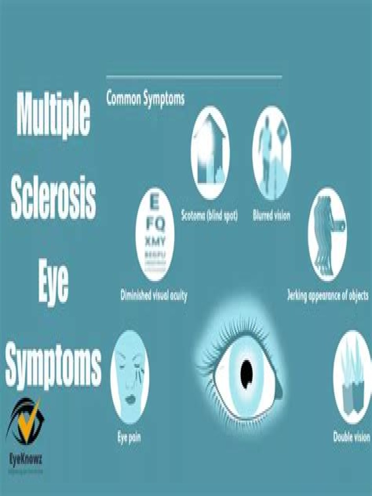 Can multiple sclerosis affect your eyes?