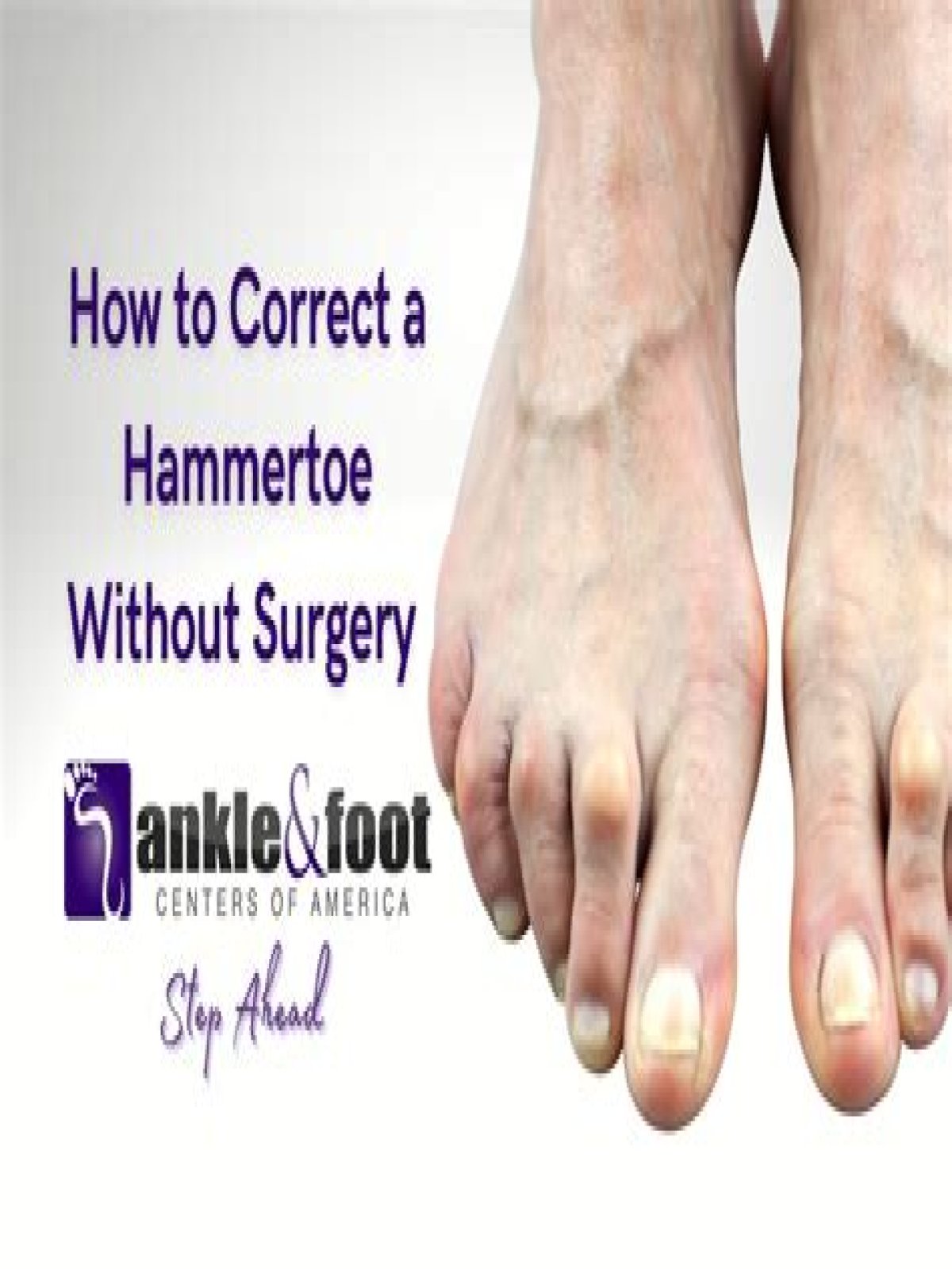 Can you reverse a hammer toe?