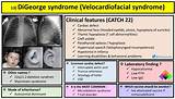 Visible Traits Vs. Reality: Identifying Digeorge Syndrome Markers in Public Figures